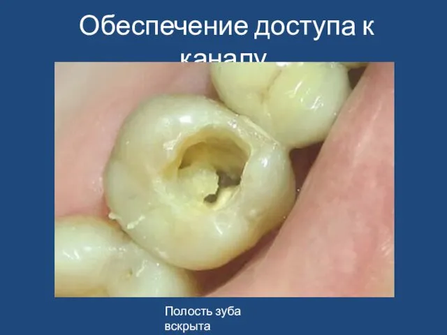Обеспечение доступа к каналу Полость зуба вскрыта