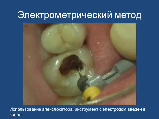 Электрометрический метод Использование апекслокатора: инструмент с электродом введен в канал