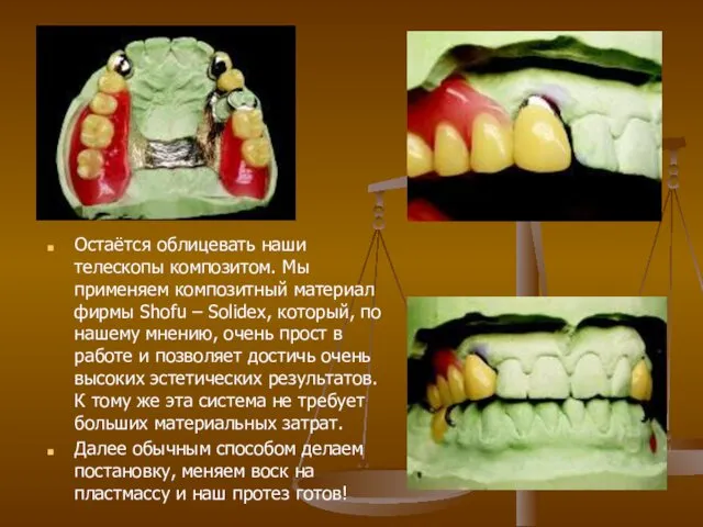 Остаётся облицевать наши телескопы композитом. Мы применяем композитный материал фирмы Shofu