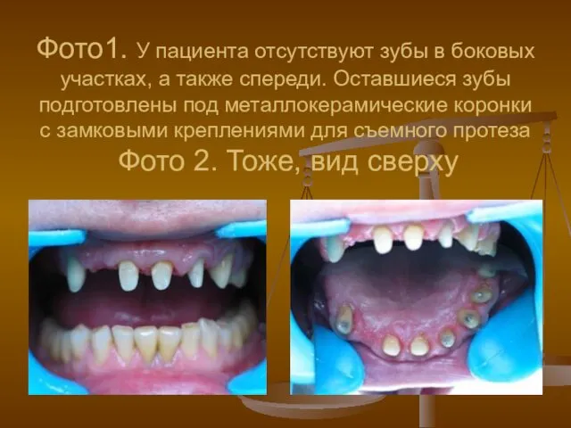 Фото1. У пациента отсутствуют зубы в боковых участках, а также спереди.