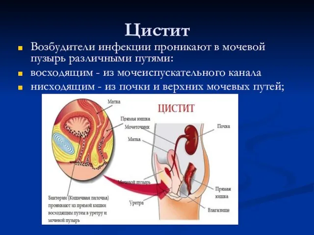 Цистит Возбудители инфекции проникают в мочевой пузырь различными путями: восходящим -