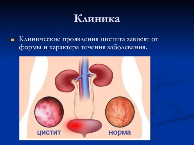 Клиника Клинические проявления цистита зависят от формы и характера течения заболевания.