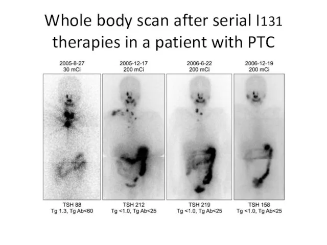 Whole body scan after serial I131 therapies in a patient with PTC