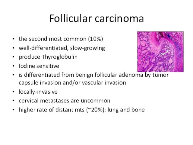 Follicular carcinoma the second most common (10%) well-differentiated, slow-growing produce Thyroglobulin