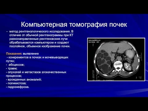 Компьютерная томография почек метод рентгенологического исследования. В отличие от обычной рентгенограммы