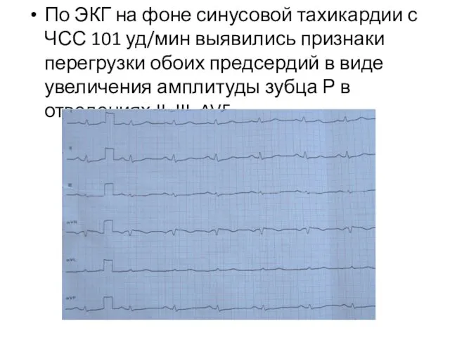 По ЭКГ на фоне синусовой тахикардии с ЧСС 101 уд/мин выявились