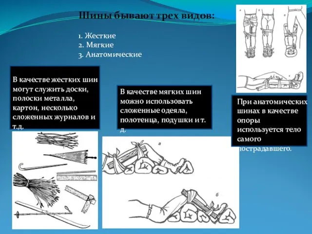 Шины бывают трех видов: 1. Жесткие 2. Мягкие 3. Анатомические В