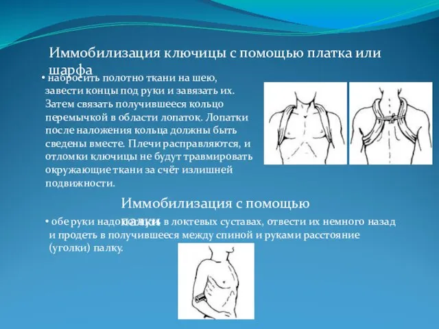 Иммобилизация ключицы с помощью платка или шарфа набросить полотно ткани на