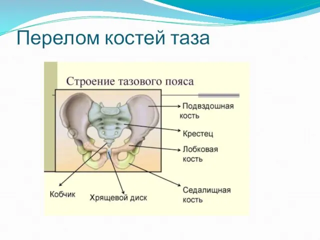 Перелом костей таза