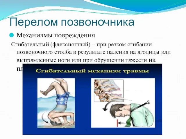 Перелом позвоночника Механизмы повреждения Сгибательный (флексионный) – при резком сгибании позвоночного