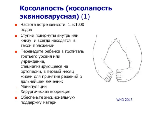 Косолапость (косолапость эквиноварусная) (1) Частота встречаемости 1.5:1000 родов Ступни повернуты внутрь