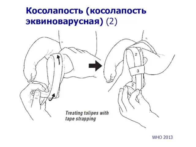 Косолапость (косолапость эквиноварусная) (2) WHO 2013