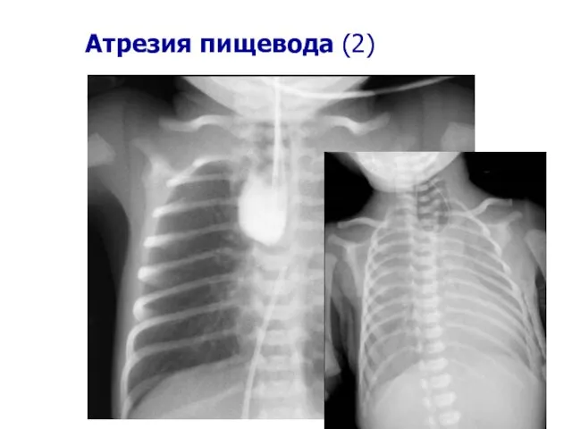 Атрезия пищевода (2)