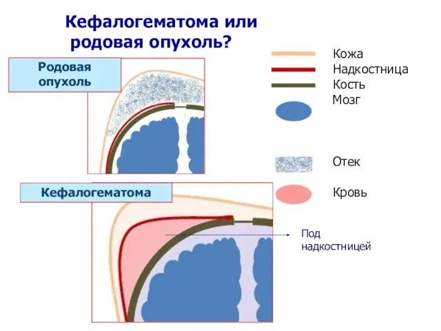 Кефалогематома или родовая опухоль? Родовая опухоль Кожа Надкостница Кость Мозг Отек Кровь Кефалогематома Под надкостницей