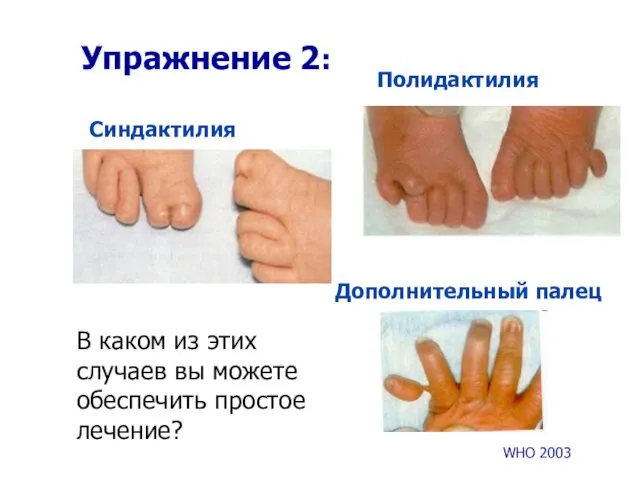 Упражнение 2: Синдактилия Полидактилия Дополнительный палец WHO 2003 В каком из