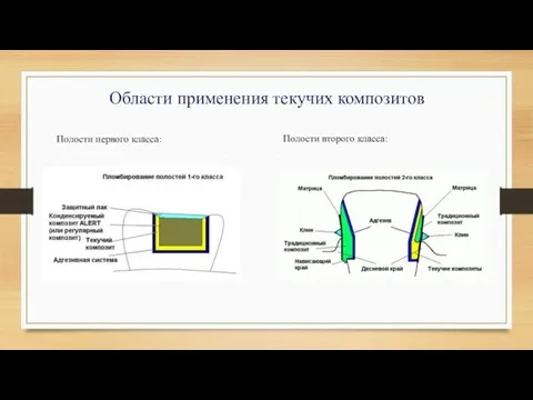 Области применения текучих композитов Полости первого класса: Полости второго класса: