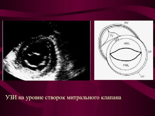 УЗИ на уровне створок митрального клапана