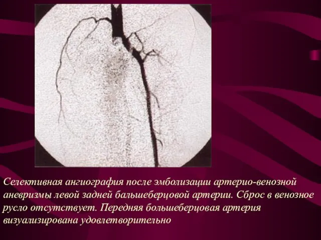 Селективная ангиография после эмболизации артерио-венозной аневризмы левой задней бальшеберцовой артерии. Сброс