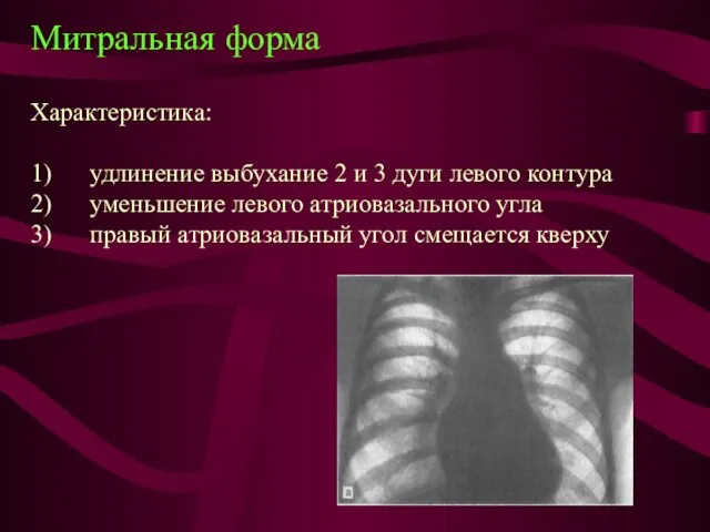 Митральная форма Характеристика: 1) удлинение выбухание 2 и 3 дуги левого