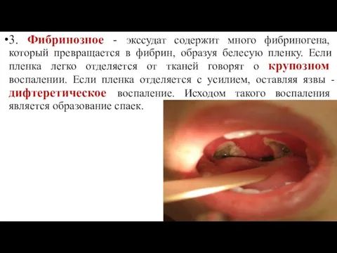 3. Фибринозное - экссудат содержит много фибриногена, который превращается в фибрин,