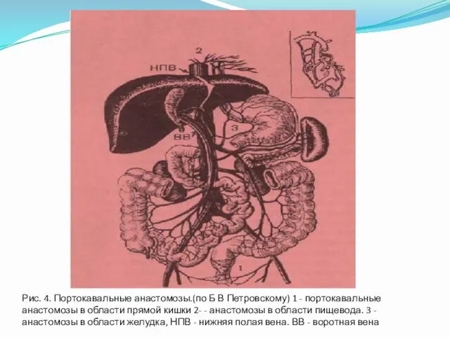 Рис. 4. Портокавальные анастомозы.(по Б В Петровскому) 1 - портокавальные анастомозы