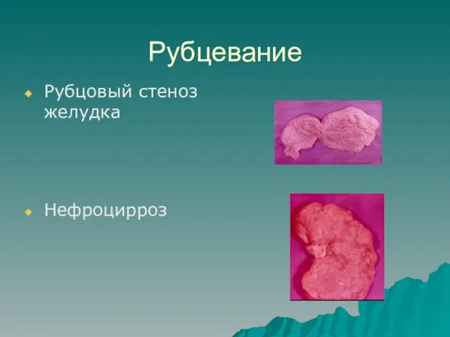 Рубцевание Рубцовый стеноз желудка Нефроцирроз