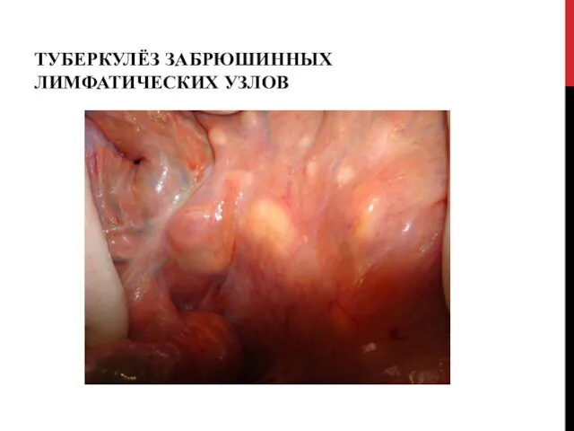 ТУБЕРКУЛЁЗ ЗАБРЮШИННЫХ ЛИМФАТИЧЕСКИХ УЗЛОВ