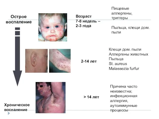 Острое воспаление Хроническое воспаление > 14 лет 2-14 лет Возраст 7-8