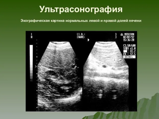 Ультрасонография Эхографическая картина нормальных левой и правой долей печени