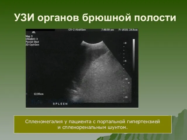 УЗИ органов брюшной полости Спленомегалия у пациента с портальной гипертензией и спленоренальным шунтом.