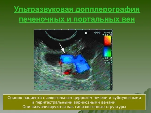 Ультразвуковая допплерография печеночных и портальных вен Снимок пациента с алкогольным циррозом