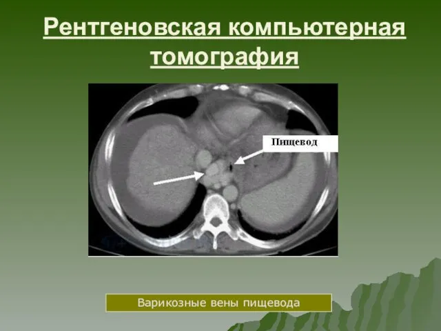 Рентгеновская компьютерная томография Варикозные вены пищевода