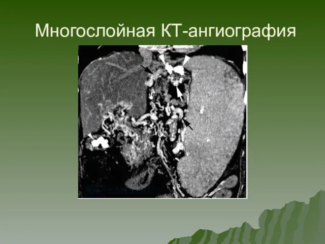 Многослойная КТ-ангиография