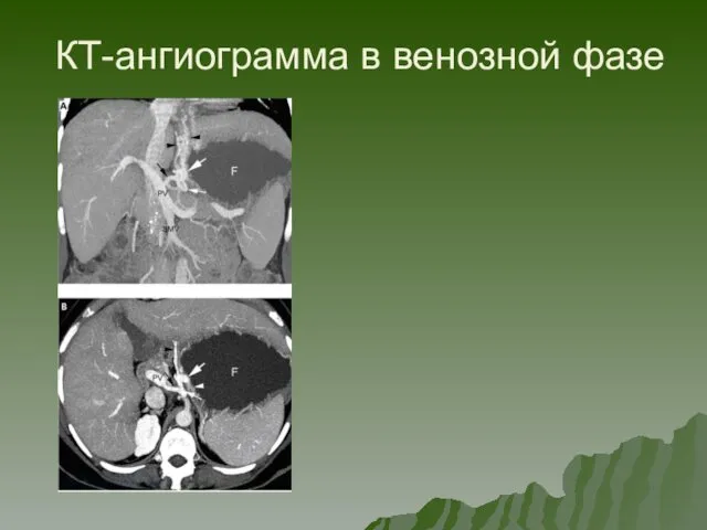 КТ-ангиограмма в венозной фазе