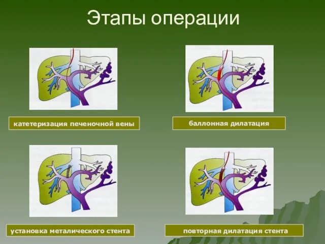 Этапы операции повторная дилатация стента установка металического стента катетеризация печеночной вены баллонная дилатация