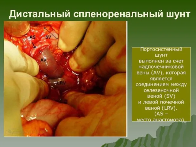 Дистальный спленоренальный шунт Портосистемный шунт выполнен за счет надпочечниковой вены (AV),
