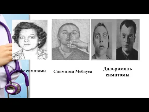 Дальримпль симптомы Сипмптом Мебиуса Грефе симптомы