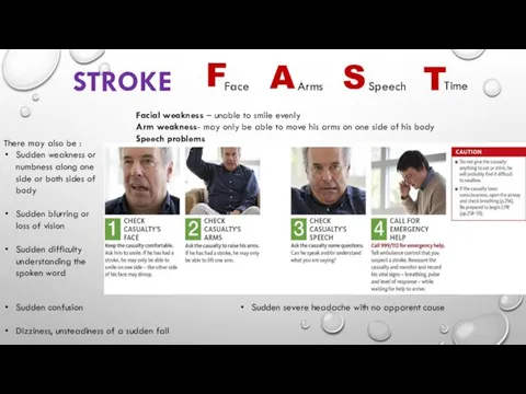 STROKE Facial weakness – unable to smile evenly Arm weakness- may