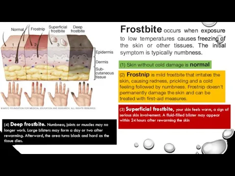 Frostbite occurs when exposure to low temperatures causes freezing of the