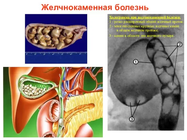 Желчнокаменная болезнь Холеграмма при желчнокаменной болезни: 1 - резко расширенный общий