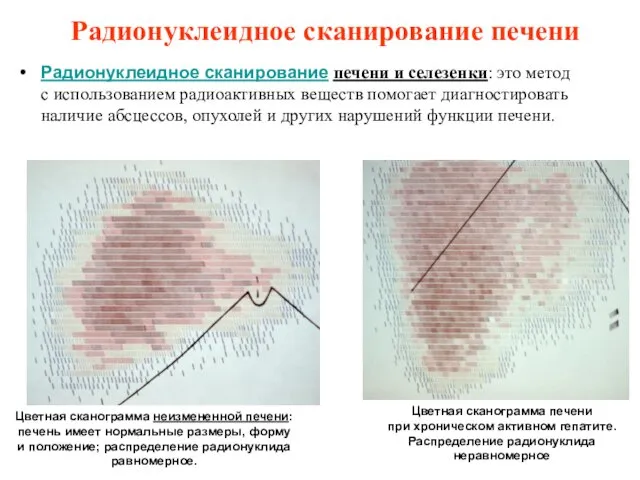 Радионуклеидное сканирование печени Радионуклеидное сканирование печени и селезенки: это метод с