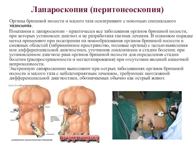 Лапароскопия (перитонеоскопия) Органы брюшной полости и малого таза осматривают с помощью