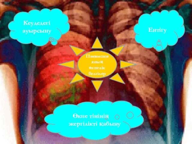 Пневмонияның өкпелік белгілер Кеудедегі ауырсыну Ентігу Өкпе тінінің жергілікті қабыну