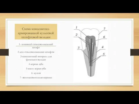 Схема композитно-армированной культевой штифтовой вкладки 1- основной стекловолоконный штифт 2-доп стекловолоконные