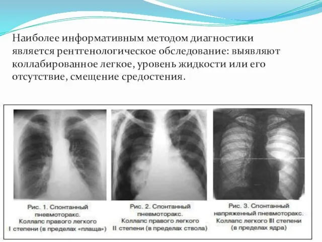 Наиболее информативным методом диагностики является рентгенологическое обследование: выявляют коллабированное легкое, уровень