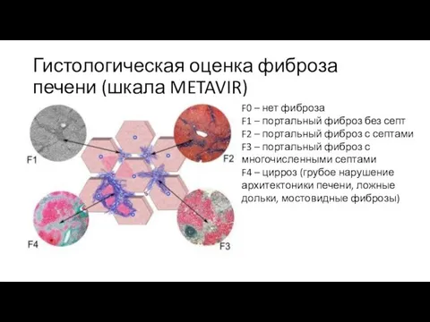 Гистологическая оценка фиброза печени (шкала METAVIR) F0 – нет фиброза F1