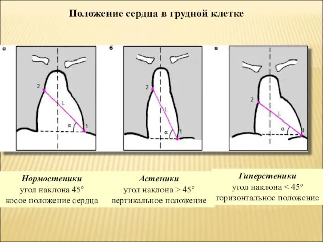 Гиперстеники угол наклона Положение сердца в грудной клетке Нормостеники угол наклона