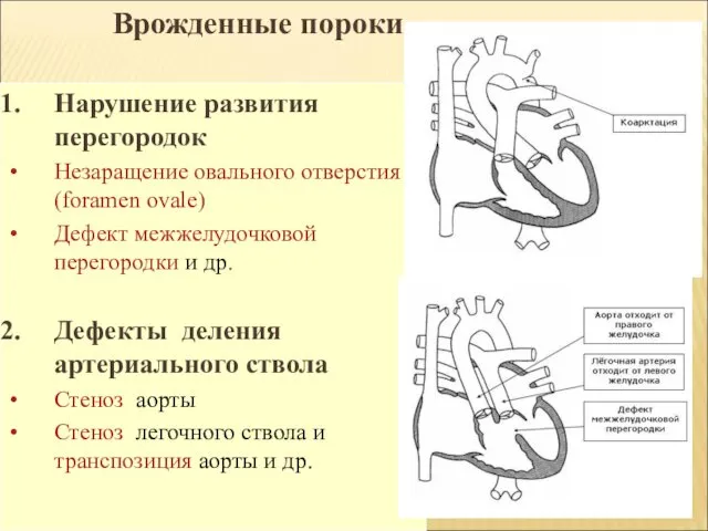 Врожденные пороки Нарушение развития перегородок Незаращение овального отверстия(foramen ovale) Дефект межжелудочковой