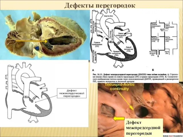 Дефект межпредсердной перегородки Дефекты перегородок