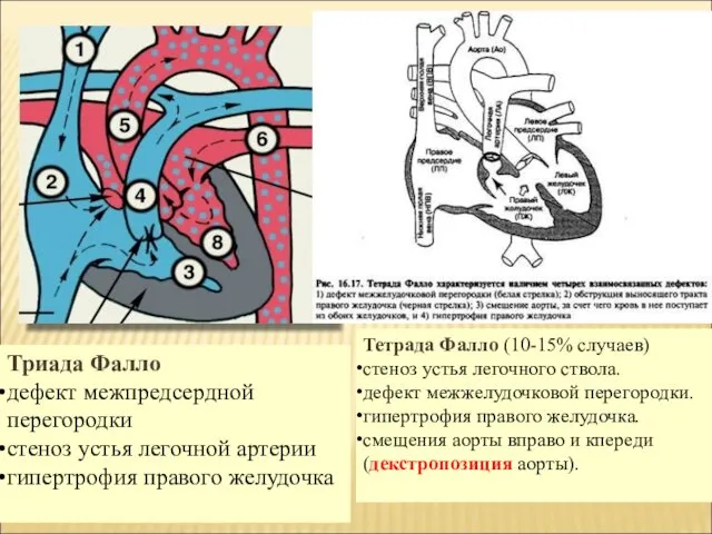 Триада Фалло дефект межпредсердной перегородки стеноз устья легочной артерии гипертрофия правого